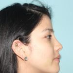 ¿Cuánto cuesta la Rinoplastía en Perú?