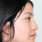 ¿Cuánto cuesta la Rinoplastía en Perú?