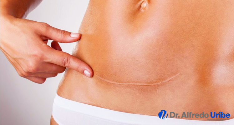 Consejos para tratar la cicatriz de una abdominoplastia