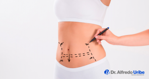 Qué es una abdominoplastia