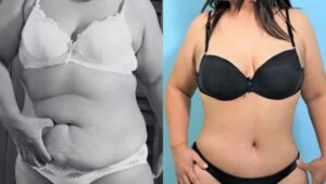 Abdominoplastia antes y después