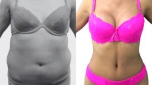 Antes y después abdominoplastia | Mantener resultados lipoescultura