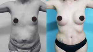 Mommy makeover antes y despues