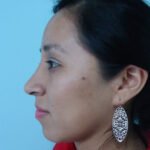 Antes y después de una Rinoplastía