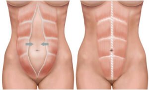 ABDOMINOPLASTIA LIPOESCULTURAL