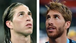 Antes y después de una Rinoplastía