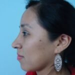 Conoce cuánto cuesta una Rinoplastía en Perú