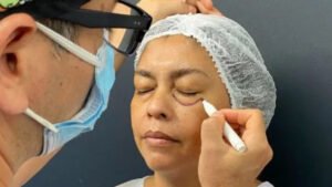 Paciente realizándose una Blefaroplastía con el Doctor Uribe