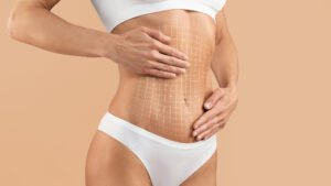Abdominoplastia