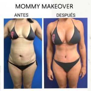 Antes y después de Mommy Makeover