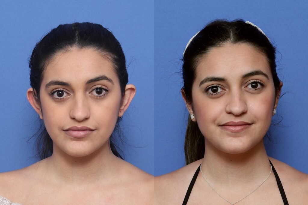 En qué te puede ayudar una otoplastia