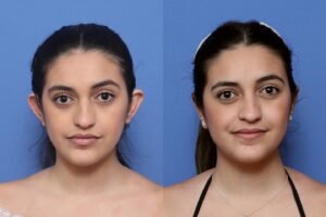 En qué te puede ayudar una otoplastia