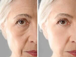 Lo que puede hacer en ti el lifting facial