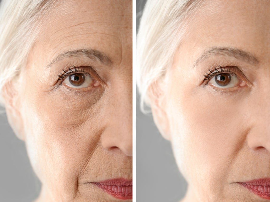 Lo que puede hacer en ti el lifting facial