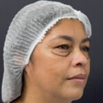 Blefaroplastía antes y después