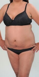 Algunos de los casos de éxito de Cirugía Estética Uribe