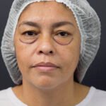 Blefaroplastía antes y después